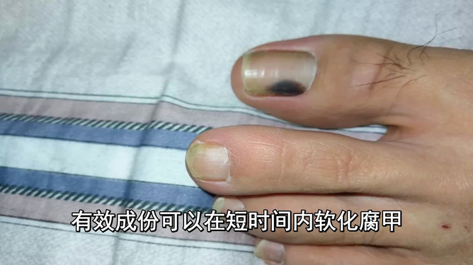 揭秘醫(yī)院治療灰指甲價(jià)格與小巷深處的特色小店探秘