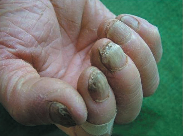 揭秘醫(yī)院治療灰指甲價(jià)格與小巷深處的特色小店探秘