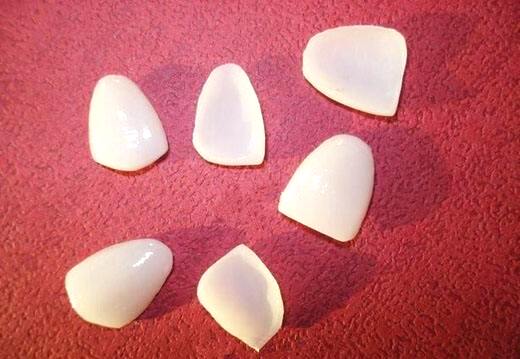 二氧化鋁全瓷牙價格變動與追求自信成就感的關(guān)聯(lián)探索