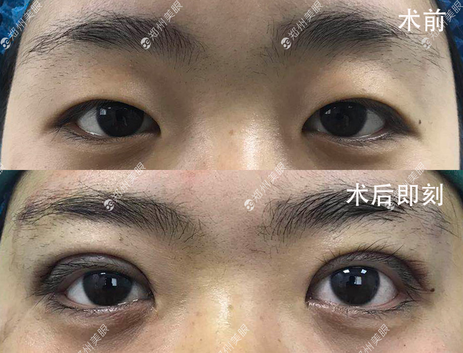 最新雙眼皮手術(shù)技巧，創(chuàng)新割雙眼皮方法解析